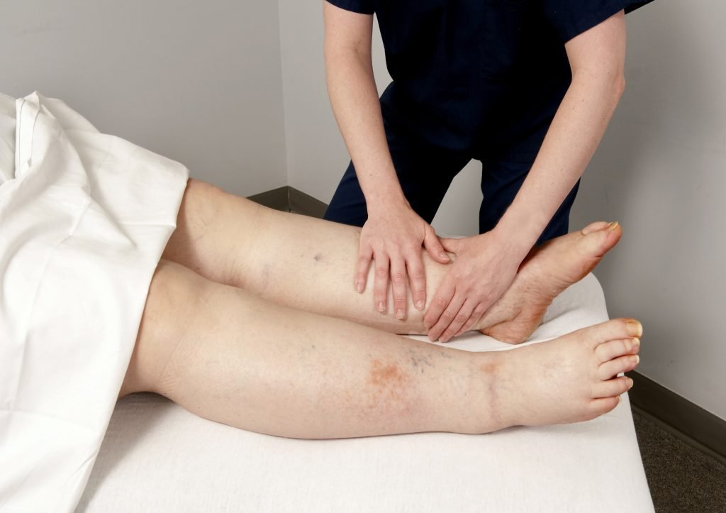 A woman’s swollen legs due to lipedema, a condition that blocks the lymphatic pathway.